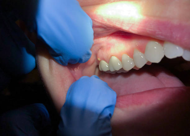 Best Emergency Tooth Extraction in Santaquin, UT